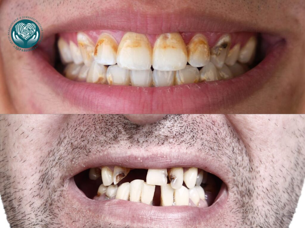Зубы после употребления амфетамина