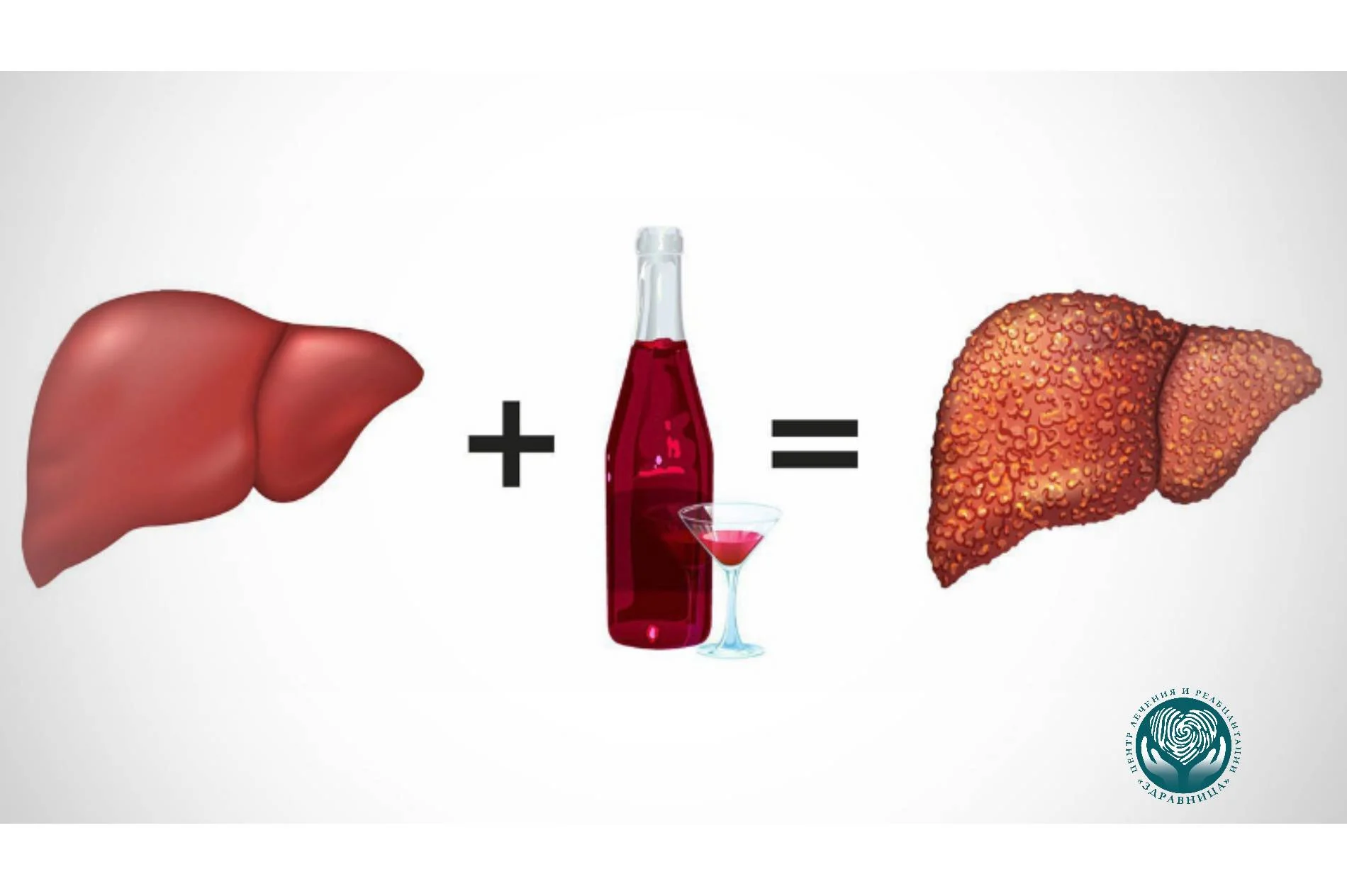 Гепатит сердце. Алкогольный цирроз печени. Цирроз печени у алкоголиков. Факторы риска алкогольной болезни печени.
