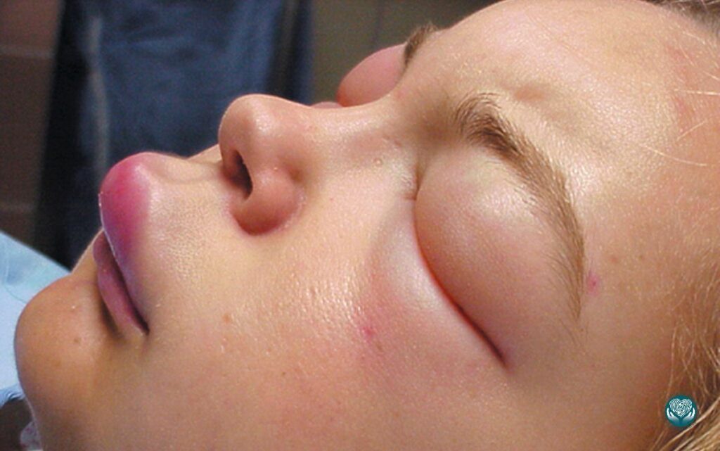 отек губ и век после употребления спиртного