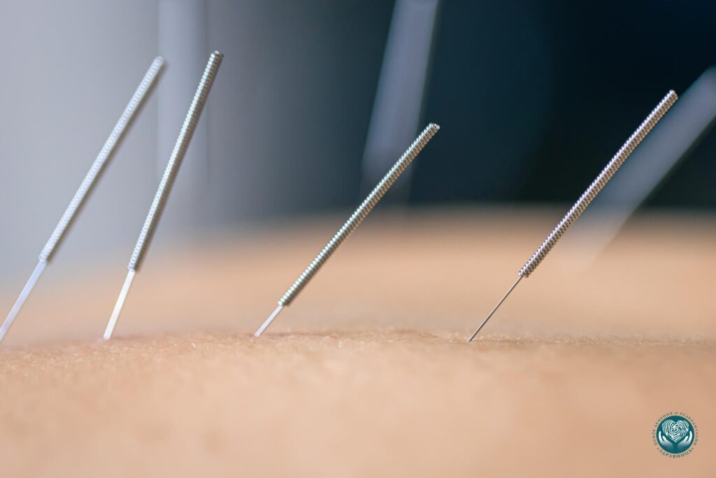 Иглоукалывание и алкоголь