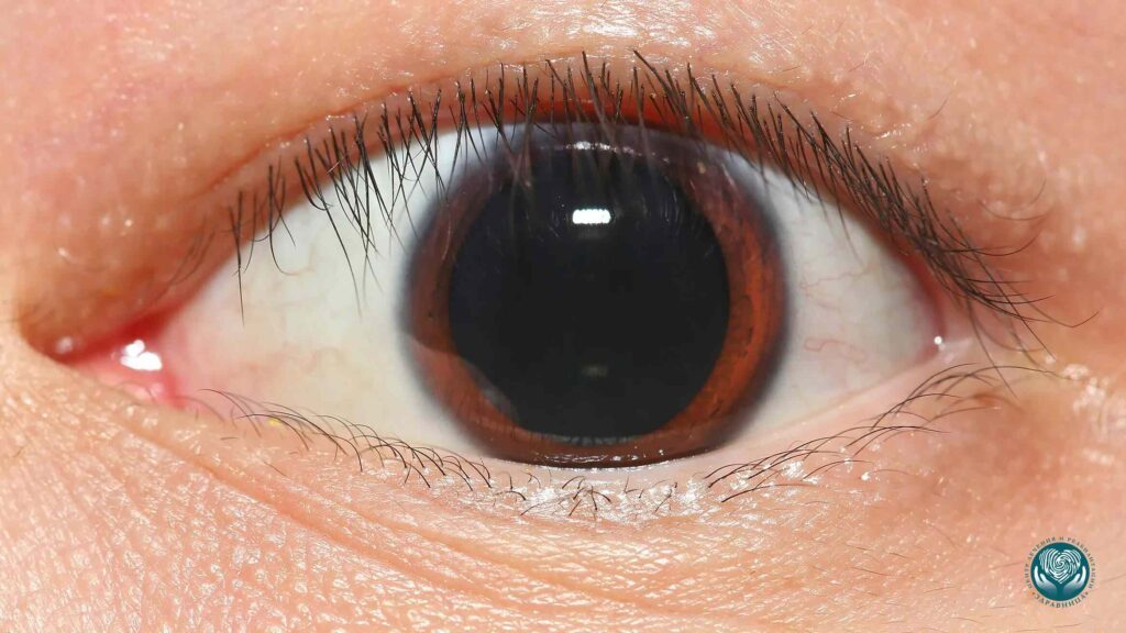 Мидриаз при употреблении стимуляторов - расширенные зрачки и возбуждение