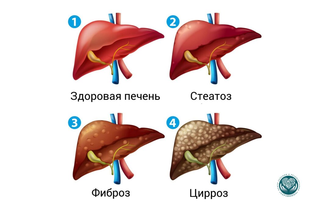 Стадии алкогольного поражения печени